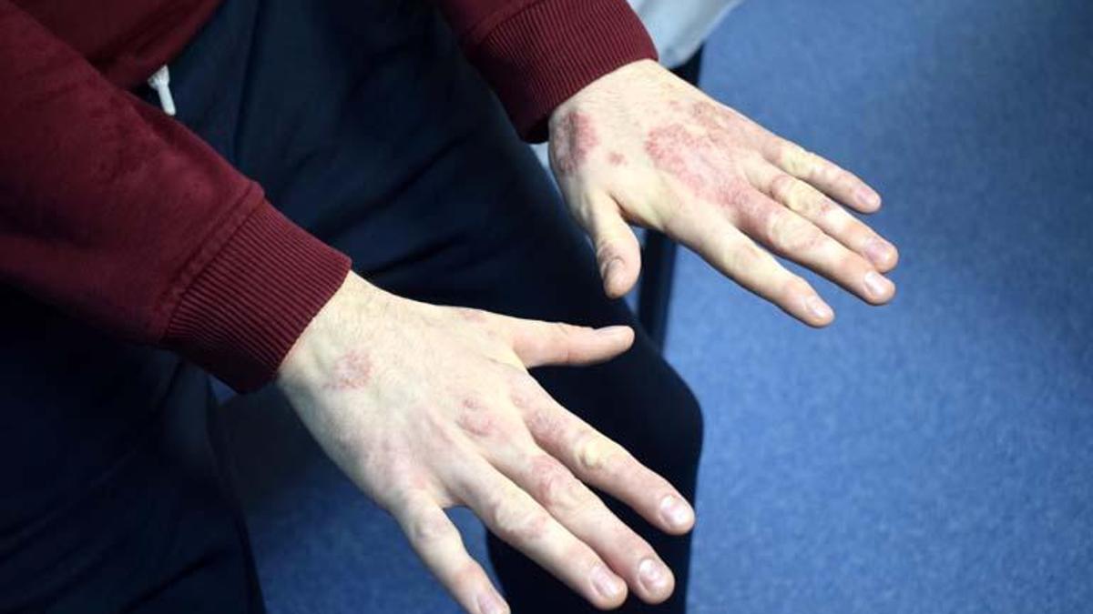 Geceleri kaşıntıdan uyutmayan hastalık! Stres ve çevresel faktörler tetikliyor